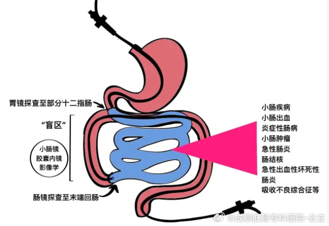 最新小肠探查技术，精准诊断小肠疾病的突破之道