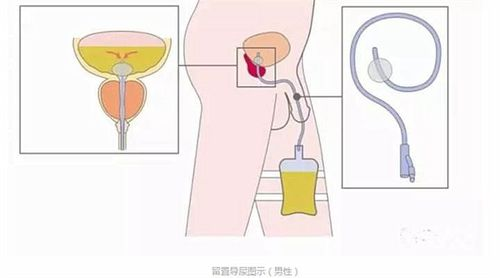 最新男性导尿技术操作指南及注意事项全解析